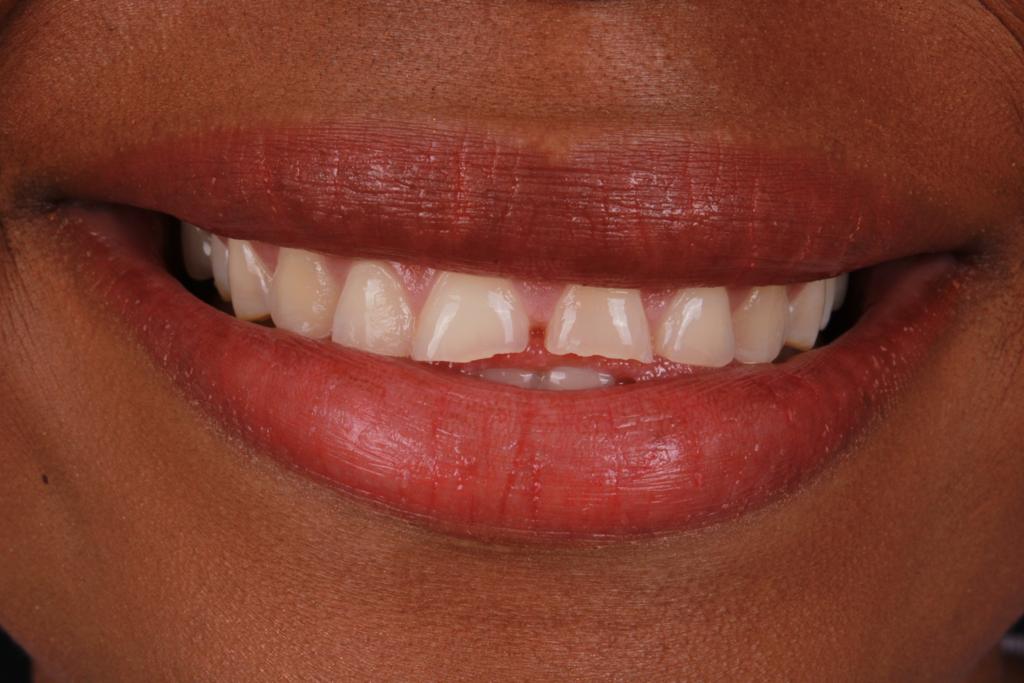 Antes diseño dental